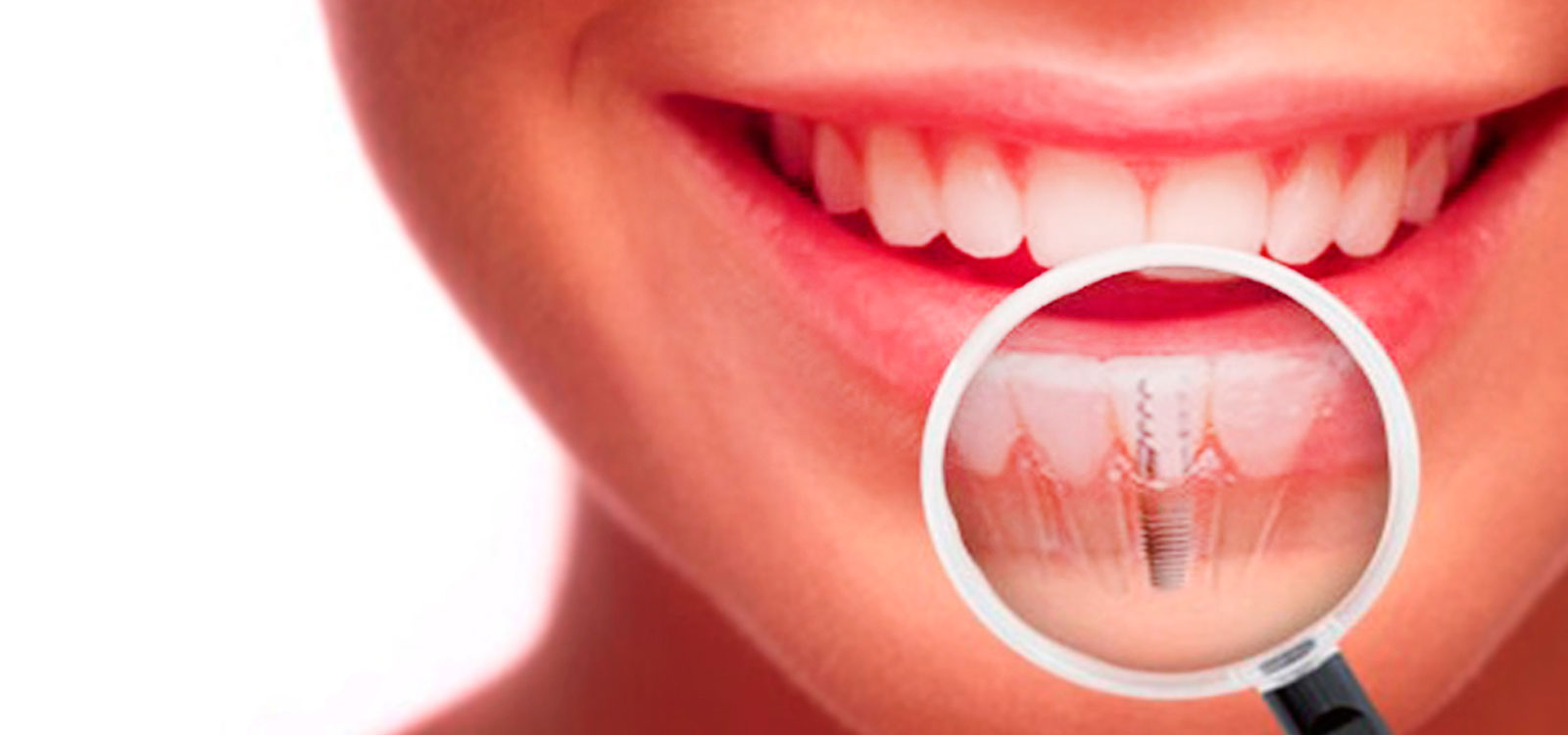 Resultado de imagen para implantes dentales
